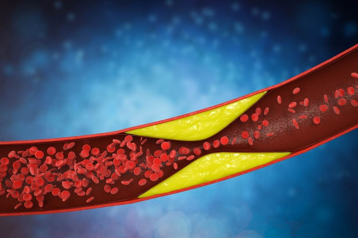 A digital image showing the inside of an artery, with blood cells flowing through and a restrictive point in the middle of the artery where plaque has built up, called atherosclerosis.